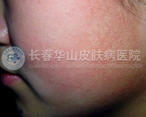 毛周角化脸部症状
