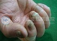 灰指甲