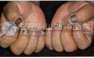 灰指甲