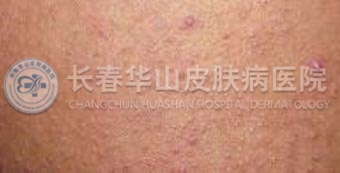 毛周角化症状