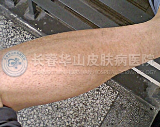 毛周角化症状