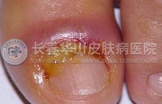 甲沟炎的症状