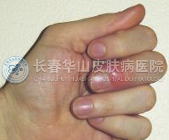 甲沟炎甲下脓肿