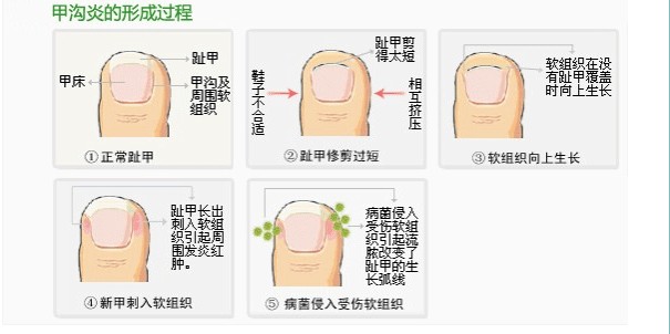 甲沟炎的形成
