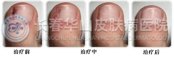 甲沟炎治疗前中后