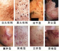 痤疮对皮肤的损害有那些