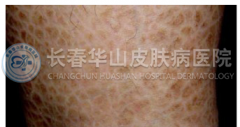 正确认识鱼鳞病症状