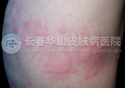 荨麻疹对身体危害有哪些?