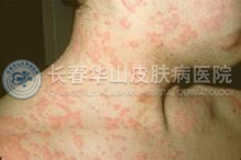 皮肤瘙痒的症状